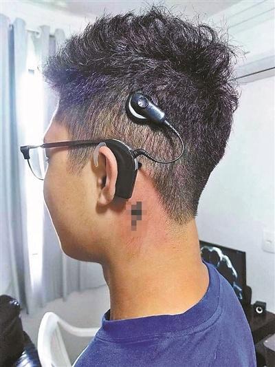 人工耳蜗