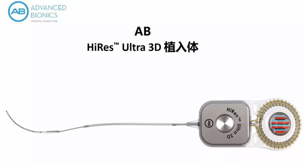 人工耳蜗