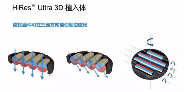 人工耳蜗