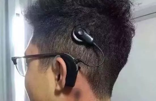 人工耳蜗