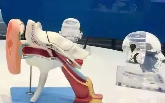 人工耳蜗