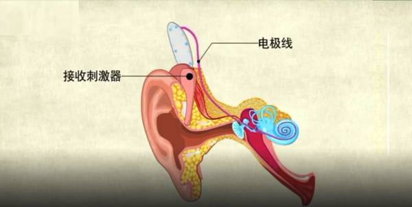 人工耳蜗