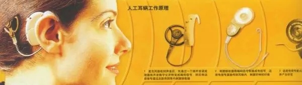 人工耳蜗