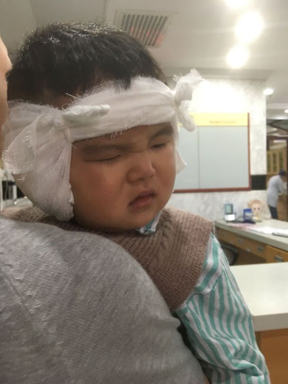 人工耳蜗