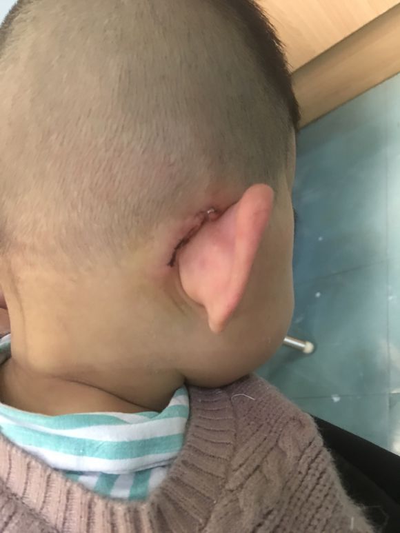 人工耳蜗