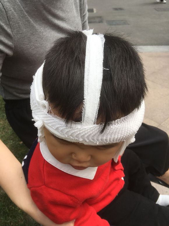 人工耳蜗
